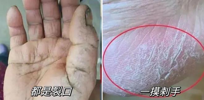 不朽情缘官网登录手足干裂的人试试这个外抹的方子一试就灵(图2)